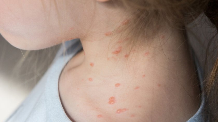 Повишение на случаите на варицела във Врачанско