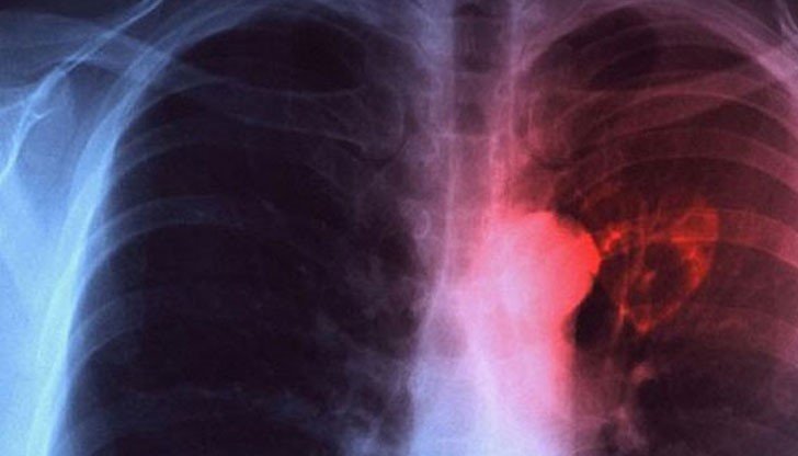 Безплатни прегледи за туберкулоза в Монтана