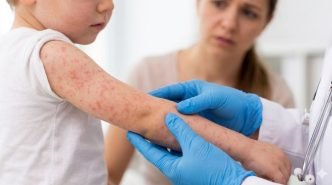 Морбили във Врачанско: Още 19 нови случая за седмица, огнището остава водещо в страната