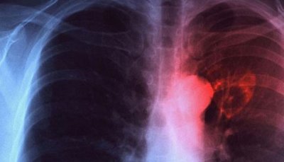 Безплатни прегледи за туберкулоза в Монтана